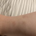 Beurer BR60 Insect Sting and Bite Relief. Bug Bite Healer for Chemical-Free Treatment of Insect Bites. Non-Toxic Natural Relief from Itching and Swelling. for Mosquito Bites
